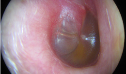 Inside close up view of a swollen and inflamed infected eardrum