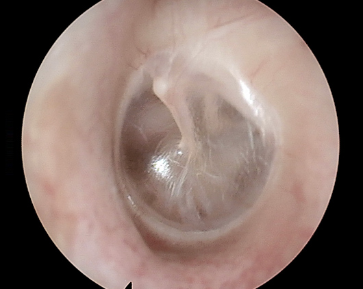 Inside close up view of a healthy eardrum