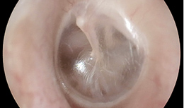 Inside close up view of a healthy eardrum