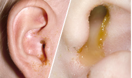 Outer view of yellow discharge from an infected ear