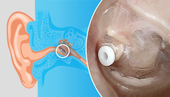 Close up view of a plastic tube, called a tympanostomy tube, inserted in middle of eardrum
