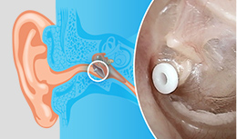 Close up view of a plastic tube, called a tympanostomy tube, inserted in middle of eardrum